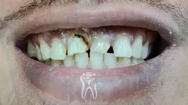 before perawatan gigi rusak