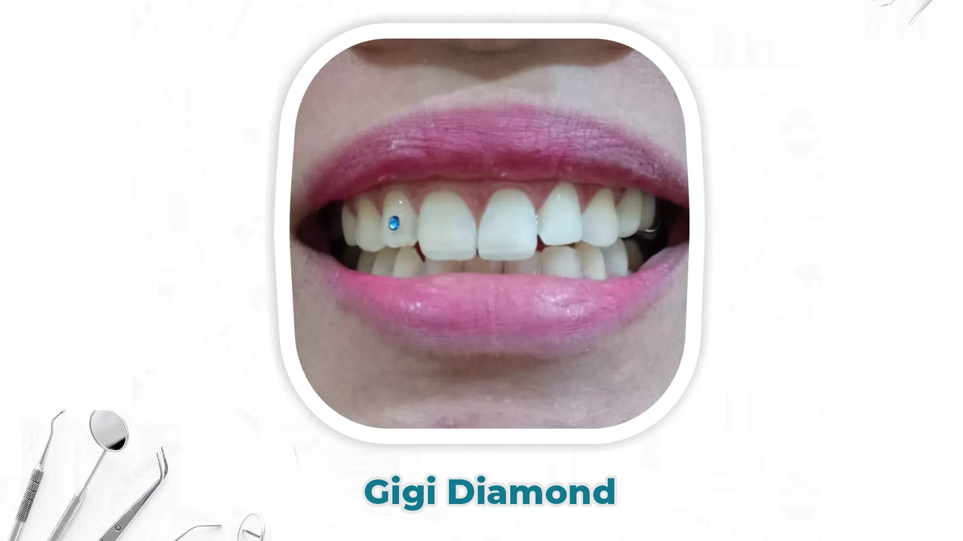Pemasangan Diamond pada Gigi
