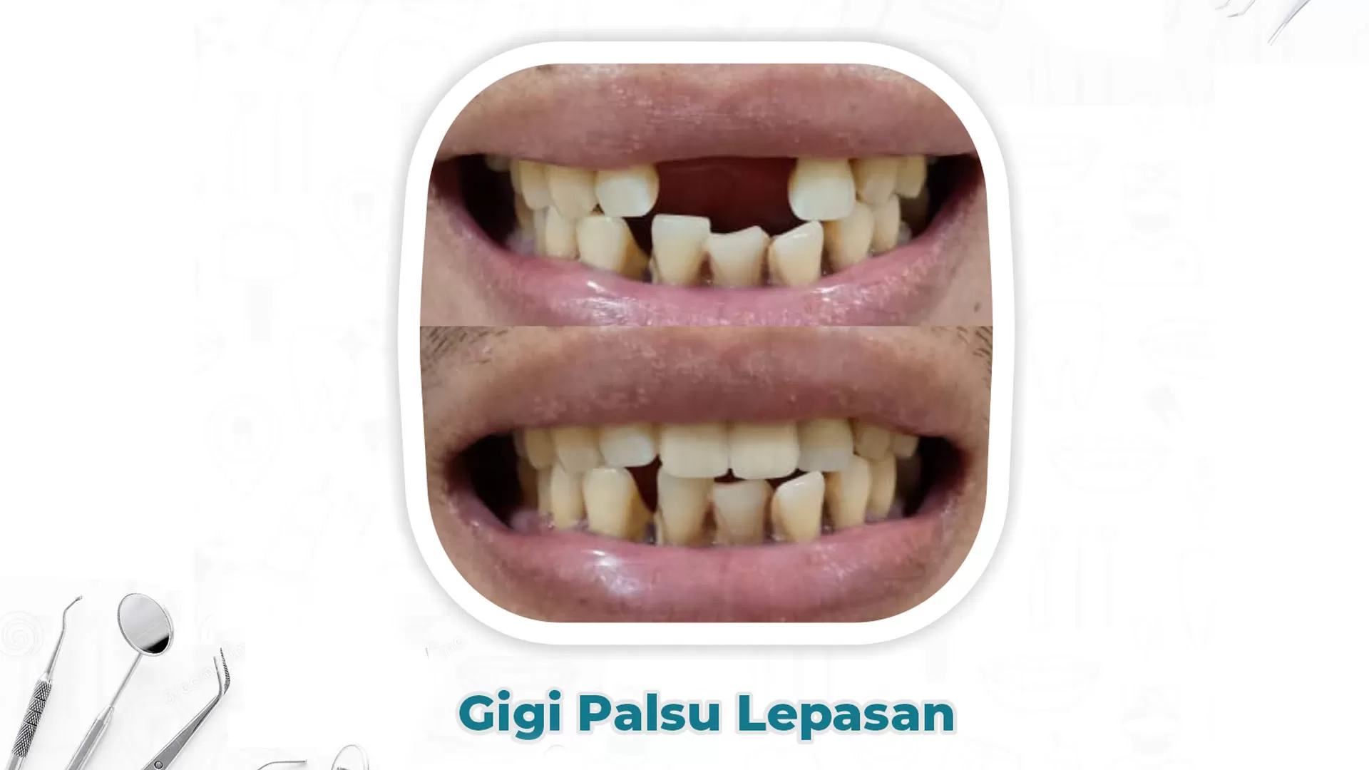 Gigi Palsu Permanen Lepas Pasang