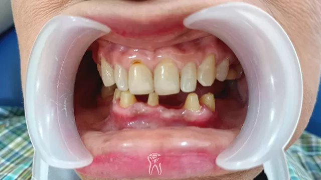 before perawatan gigi rusak